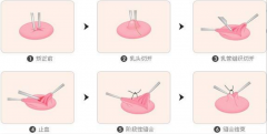 乳头凹陷矫正术后注意事项?