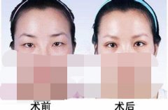 呼和浩特双眼皮哪家医院效果好?