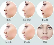 呼和浩特隆鼻后呼吸不通畅怎么办?