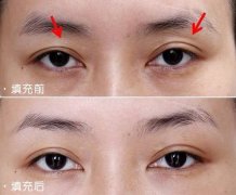 呼和浩特整形眼窝凹陷怎么修复好呢?