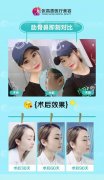 想要隆鼻五花八门的方式怎么选?