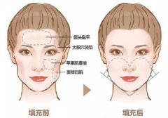 下巴整形会有危险吗?