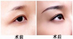 纹眉会有危险吗?