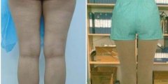 大腿吸脂手术后会不会反弹呢?