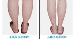 吸脂瘦大腿会不会有危险吗?