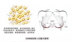 丰胸整形会不会有安全隐患呢?
