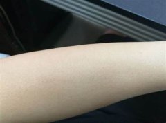 激光手臂脱毛会不会痛呢?
