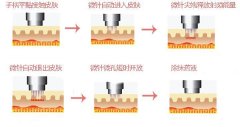 注射botox去除腋臭效果怎么样?