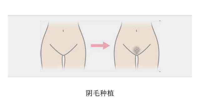 呼和浩特阴毛整形术前术后需要注意什么?
