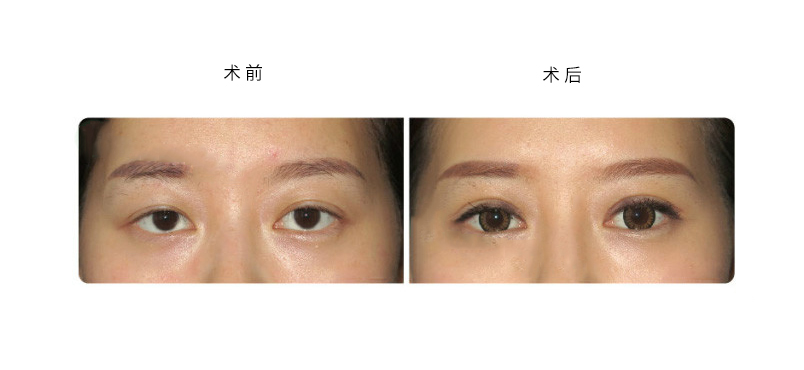 呼市割双眼皮伤口清洁和那些有关?