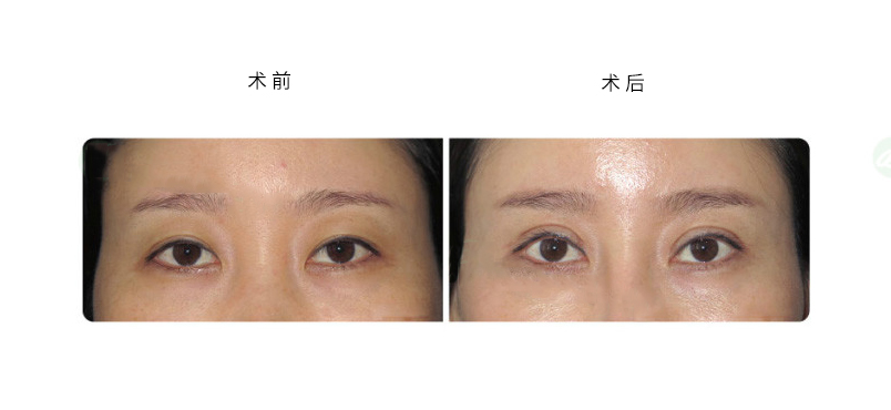 呼和浩特市双眼皮副作用有哪些?