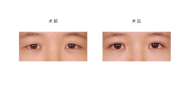 呼和浩特市割双眼皮适合多大年龄呢?