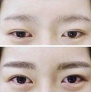呼市黑眼圈如何治疗?