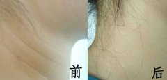 呼市射频紧肤除皱费用贵吗?