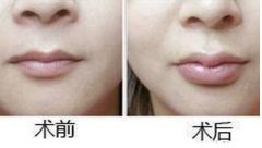 呼市丰唇方法好吗怎样护理?