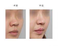 呼市假体隆鼻手术过程有哪些?