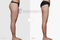 呼市大腿吸脂副作用怎么样?