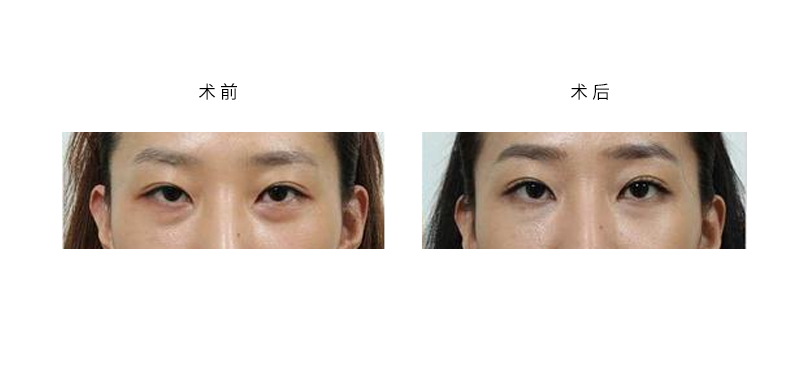 呼市双眼皮做坏了能改好吗?