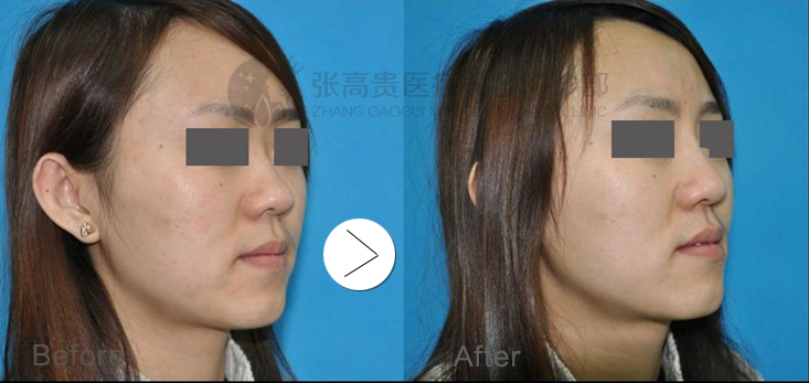 呼市膨体隆鼻好不好?