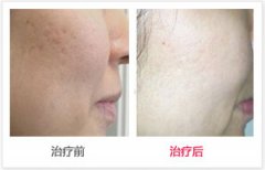 呼市铂金美白针效果与价格有哪些?
