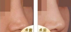 呼市鼻孔缩小术怎么做?