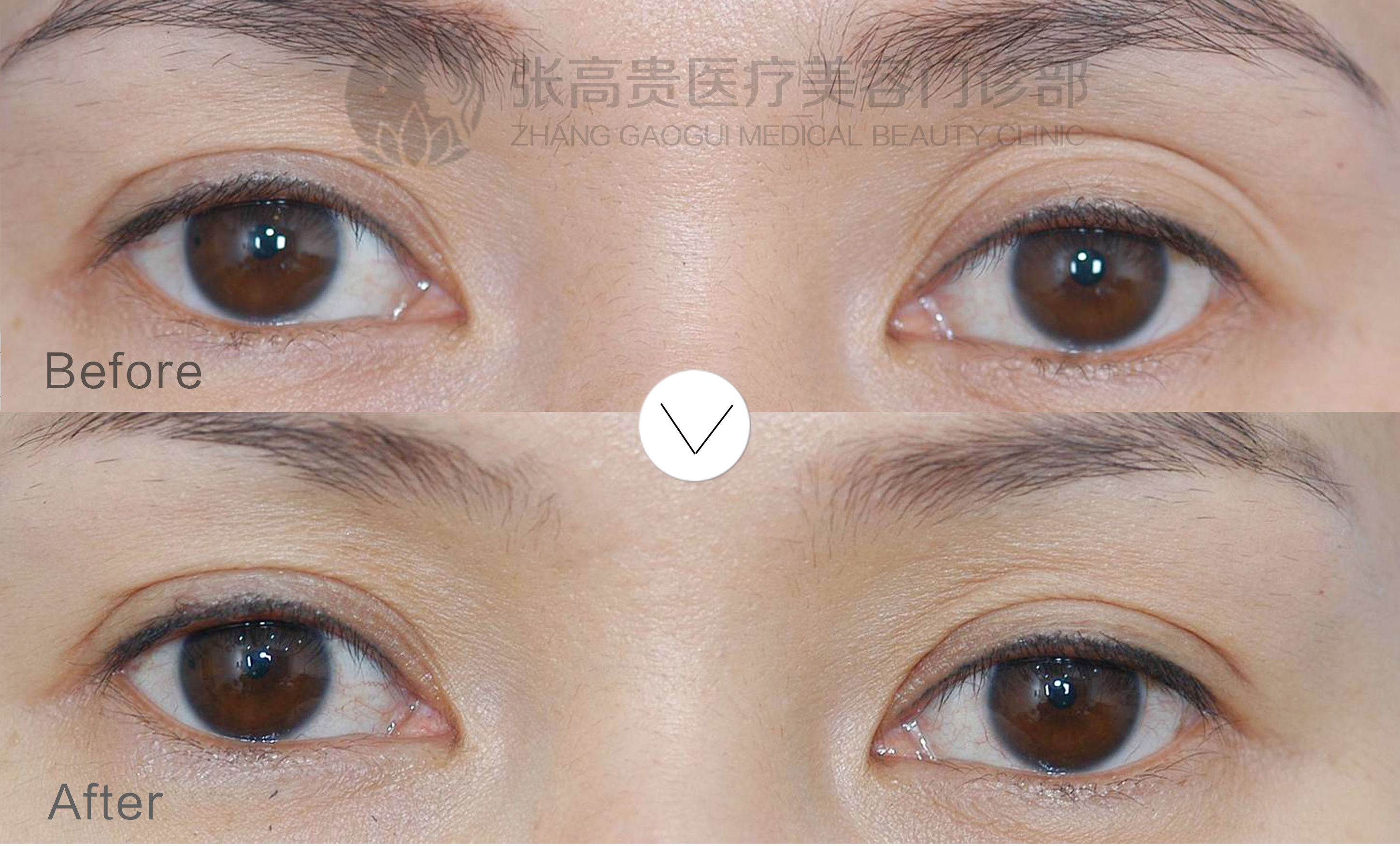 呼市提眉术效果好不好?