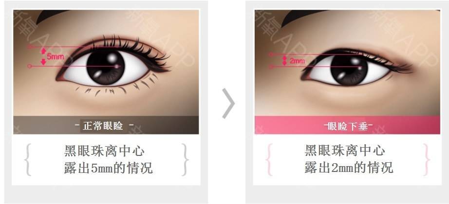 呼市如何矫正眼睑下垂?