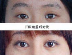 呼市开眼角手术安全吗?