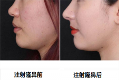 呼市注射隆鼻修复有哪些方法?