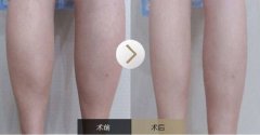 呼市射频瘦小腿效果怎样?