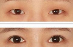 呼市开眼角手术适合哪一种?