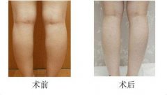 呼市小腿吸脂减肥哪些特点呢?