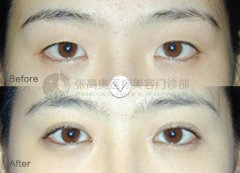 呼市开眼角术后会有痕迹吗?