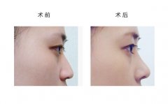 呼和浩特鼻翼肥大怎么改善呢?