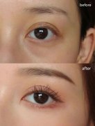 呼和浩特去黑眼圈注意事项有哪些?