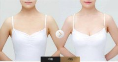 <b>隆胸假体材料和年龄有关吗?</b>