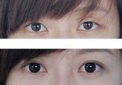 双眼皮手术是怎么设计的呢?