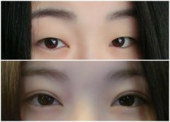 埋线双眼皮操作过程是什么样的?