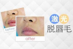 唇部脱毛贵不贵?注意事项是什么?