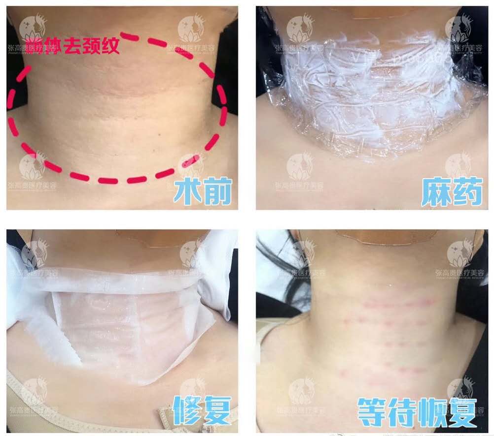 【嗨体去颈纹】从火鸡脖到天鹅颈,你只需这样做!