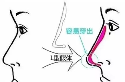 戴着口罩颜值高?教你两招搞定“扁平脸”呼市整形医院