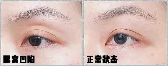 年纪轻轻就眼窝凹陷,该咋“整”?呼市整形医院
