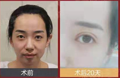 我是肿泡眼,医生却说我不能去脂肪,这是为什么?
