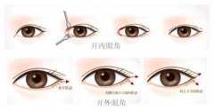 开内眼角为什么眼睛会变大