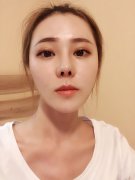 肋软骨隆鼻手术的效果是怎么样的