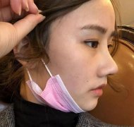 做自体隆鼻手术都有那几种呢