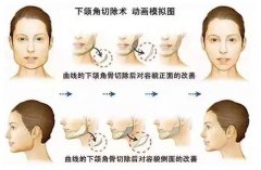 下颌角削骨手术是怎样进行的