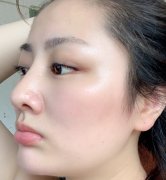 做膨体隆鼻手术需要多少钱