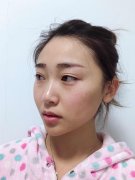 呼和浩特做面部吸脂的手术方法有哪些呢