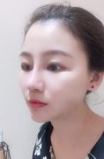 自体软骨隆鼻和注射隆鼻哪个好